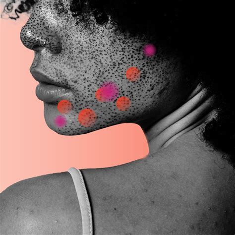 How to get rid of cystic acne once and for all – Artofit