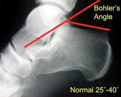 Which Calcaneus Fractures Should I Operate On?