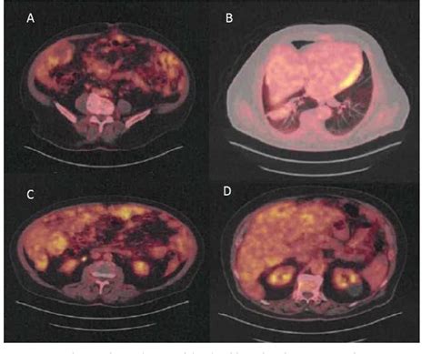 Primary Peritoneal High Grade Serous Carcinoma In A Man A Case Report