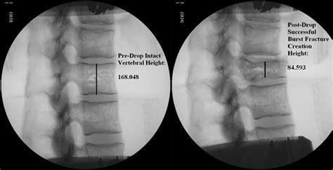 Is Lateral Stabilization Enough In Thoracolumbar Burst Fracture