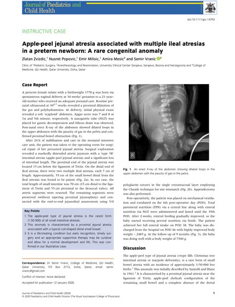 Pdf Apple Peel Jejunal Atresia Associated With Multiple Ileal