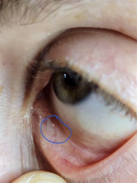 What is this white bump in my eye? : r/AskDocs