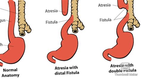 Tracheoesophageal Fistula Tef And Its Types Youtube