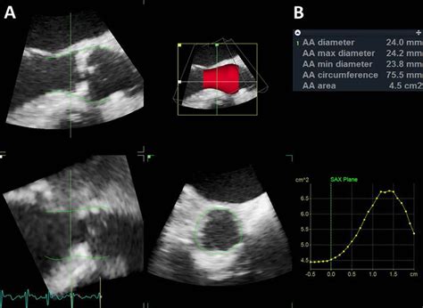 Automated Dimensional Transesophageal Echocardiography Analysis Of