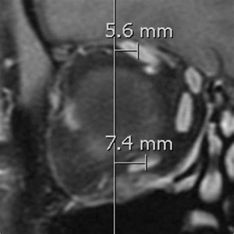 Inferior and superior rectus muscle location in heavy eye syndrome ...