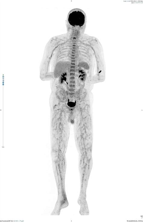 Whole Body Maximum Intensity Projection Mip Demonstrates Increased