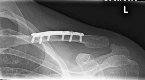 Repairing Broken Bones Of The Collar Boneclavicle Dr Edward Weldon