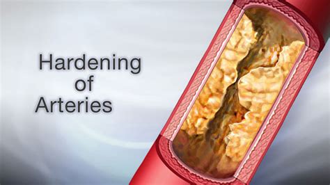 Reverse Hardening Of The Arteries Faqs