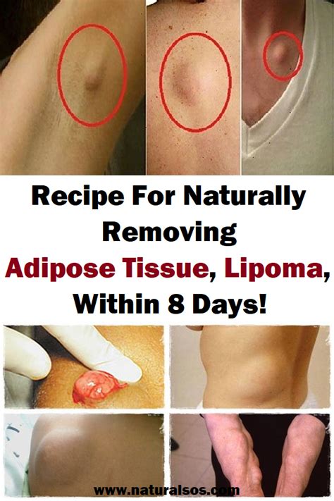 Recipe For Naturally Removing Adipose Tissue Lipoma Within 8 Daysrecipe Remedy Lipoma