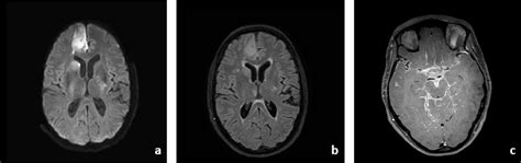 Pdf Vasculitis And Ischemic Stroke In Lyme Neuroborreliosis