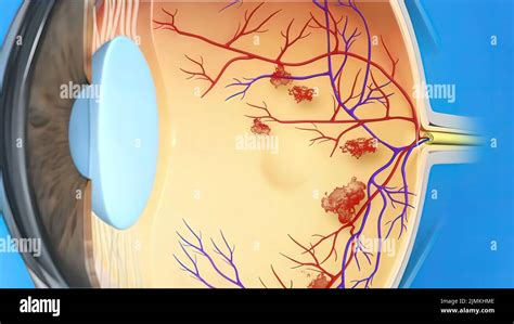 Diabetic Macular Edema Hi Res Stock Photography And Images Alamy