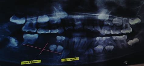 Orthopantomogram Revealed Ai Ill Defined Multilocular Radiolucency