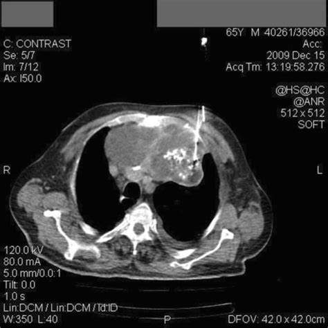 Ct Scan Reevaluation After 4 Months Download Scientific Diagram