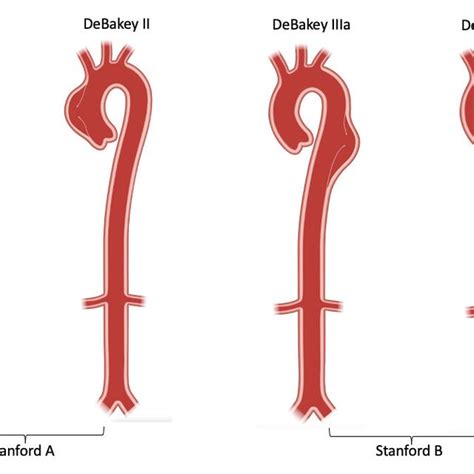 DeBakey and Stanford aortic dissection classification. | Download ...