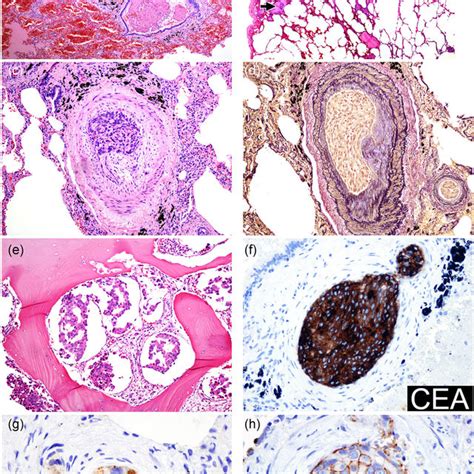 Extramammary Pagets Disease Empd In The Left Axilla 4 Years Ago