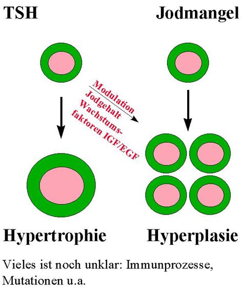 Hyperplasie; hyperplasias