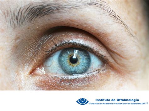 Cirug A De Glaucoma En M Xico Tratamiento Para Retinopat A Diab Tica