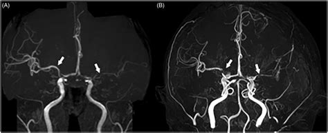 A Brain Magnetic Resonance Mr Angiography Partial Maximum