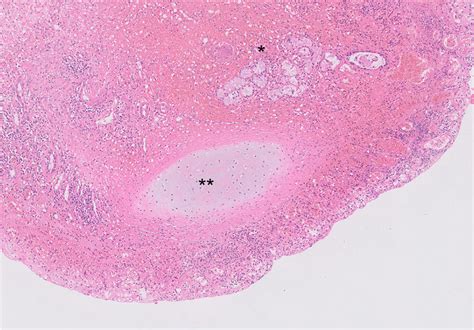 Pathological Findings Of The Cyst Wall Hematoxylin And Eosin Stain