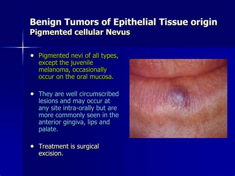 PPT Comprehensive Guide To Benign Oral Tumors PowerPoint Presentation