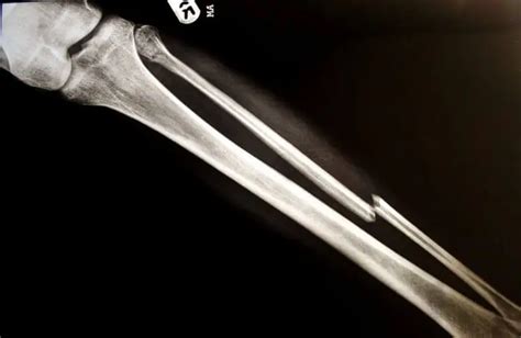 Dangers from a Fractured Bone