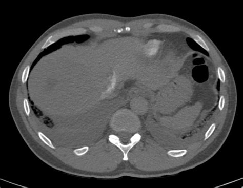 101H Cardiogenic Pulmonary Edema CXR and CT | Heart