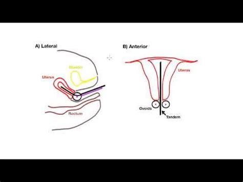 MedPhys - 26.3 - Brachytherapy Applications: High-dose rate (HDR) brachy. - YouTube