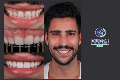 Diseño de Sonrisa digital Dubai Dental Studio