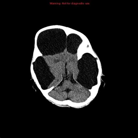 Hydranencephaly Radiology Case Radiology