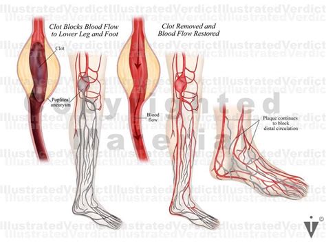 Stock Lower Limb Clots Plaques In Vasculature Illustrated Verdict