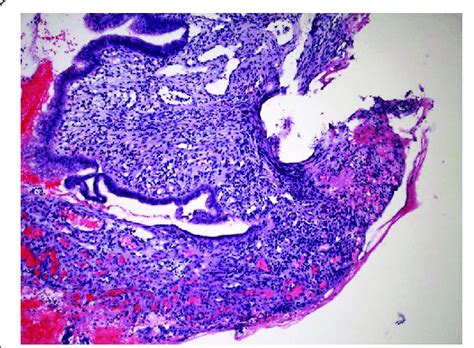 Duodenal Biopsy Showing Ulceration From Nsaid Abuse Download