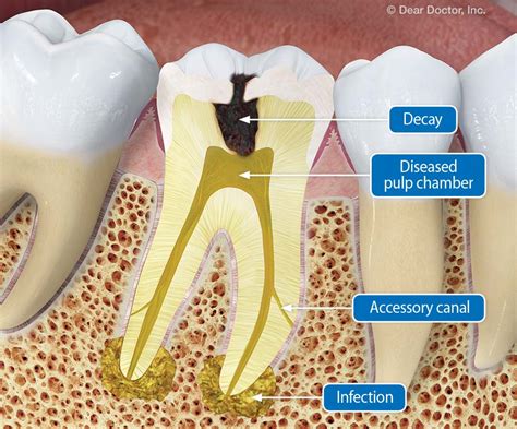 Root Canal Treatment What You Need To Know