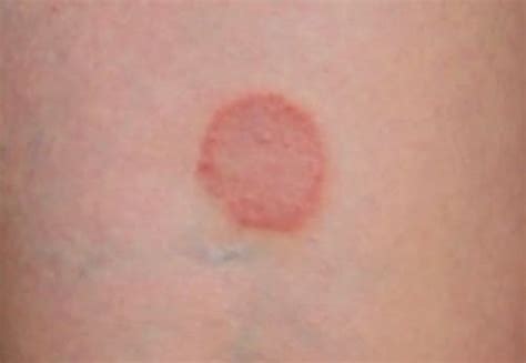 Ringworm: Images, Causes, Symptoms, Treatment - HubPages