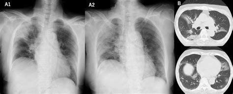 Axial Images Of Hrct And Posteroanterior Chest Radiograph Of Patient