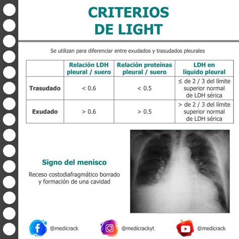 pañuelo para agregar tanto criterios de light derrame pleural