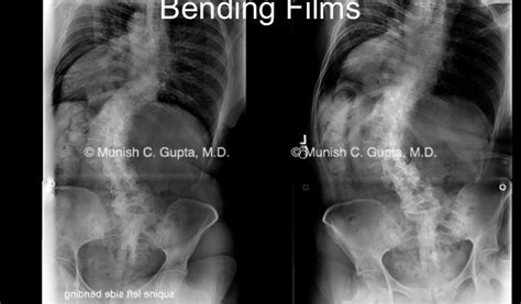 Adult Idiopathic Scoliosis Munish C Gupta Md