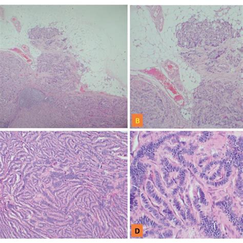 inmunohistoquímica ihq A Sinaptofisina positiva difusa patrón