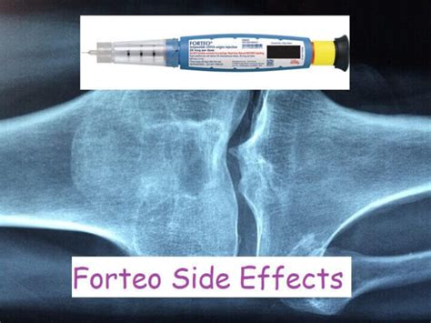 Forteo Side Effects, Usage, How To Use It » 2023