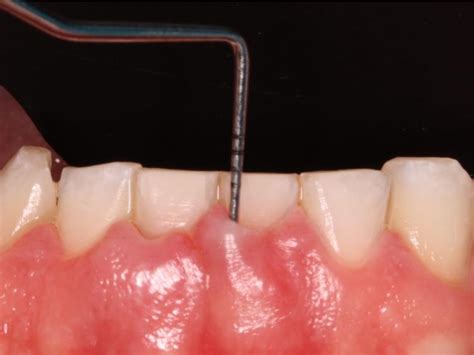 Periodontal Probing Download Scientific Diagram