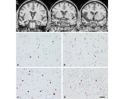 Neuroimaging And Pathological Findings In A Case With AD And TDP 43