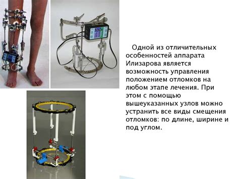 Аппарат Илизарова - online presentation