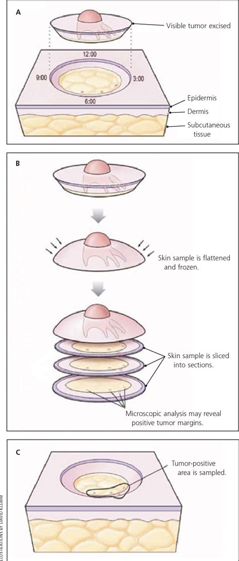 Figure 1 From Mohs Micrographic Surgery Semantic Scholar