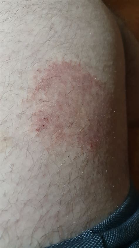 Whats This Rash Rdermatologyquestions