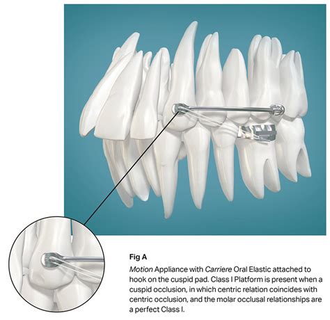 Carriere Motion Class Ii Henry Schein Dental Orthodontics