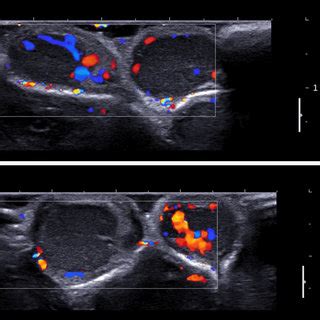 Experience Of Using Shear Wave Elastography In Evaluation Of Testicular