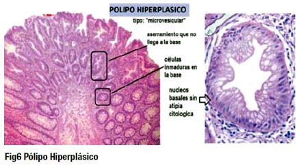 O Que É Polipo Hiperplasico - Polipo Hiperplasico Evaluación De Los Pólipos Gástricos En