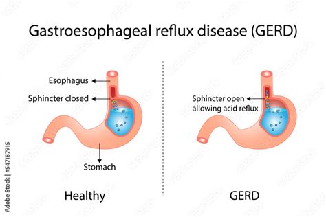 Vetor De Gastroesophageal Reflux Disease Gerd Heartburn Heartburn