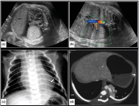 Figure From Solitary Round Pulmonary Lesions In The Pediatric