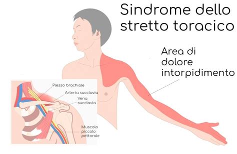 La Sindrome Dello Stretto Toracico Cgm Fisioterapia