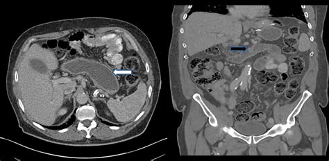 Biliopancreatic Limb Obstruction After Laparoscopic Rouxeny Gastric